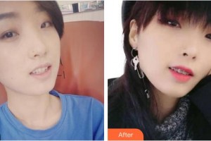 成都華顏醫(yī)療美容門診部曾小娟整形價(jià)格表附牙齒隱形矯正案例展示