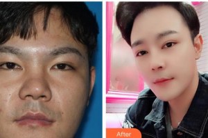 成都艾尚醫(yī)學(xué)美容門診部劉銘整形價(jià)格表附鼻部手術(shù)整形案例展示