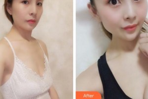成都雙楠醫(yī)院整形美容科李映雨整形價(jià)格表附豐胸案例展示