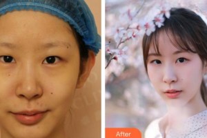 成都華倫鉑尚醫(yī)療美容診所吳細(xì)輕整形價(jià)格表附水光補(bǔ)水祛暗沉案例展示