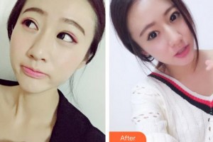 成都恩喜醫(yī)學(xué)整形美容醫(yī)院徐踴整形價(jià)格表附光子嫩膚案例展示