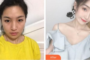 成都恩喜醫(yī)學整形美容醫(yī)院李成煥整形價格表附鼻部大改造-鼻部多項案例展示