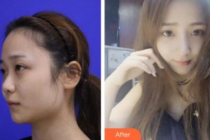 成都天之美醫(yī)療美容診所劉寧整形價(jià)格表附鼻部綜合案例展示