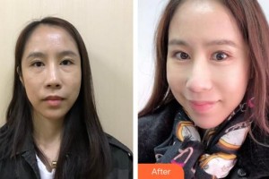 成都艾美醫(yī)療美容門診部魏東整形價格表附眼部綜合案例展示