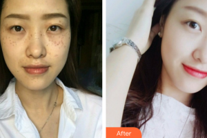 廣州新時(shí)代整形美容醫(yī)院劉曉莉整形價(jià)格表附超激光美膚祛斑案例展示