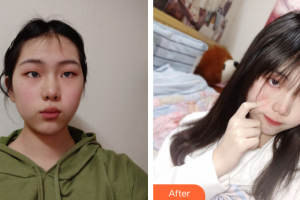 廣州利美康粵美醫(yī)療美容門診部周碧燕整形價(jià)格表附超激光美膚案例展示