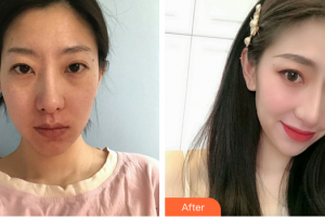 廣州曙光醫(yī)學(xué)美容醫(yī)院杜錫萍整形價(jià)格表附光子嫩膚案例展示