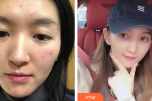 廣州新時(shí)代整形美容醫(yī)院紀(jì)麗萍整形價(jià)格表附微針祛痘 案例展示