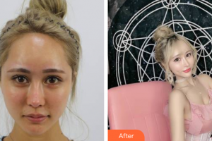 廣州珈禾整形美容門診部石冰整形價(jià)格表附酒窩成形術(shù)案例展示