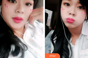 廣州曙光醫(yī)學(xué)美容醫(yī)院熊飛整形價(jià)格表附冷光美白案例展示