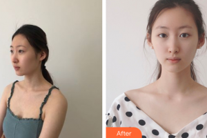 廣州曙光醫(yī)學(xué)美容醫(yī)院項(xiàng)蕾紅整形價(jià)格表附光子嫩膚案例展示