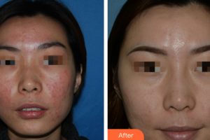 廣州曙光醫(yī)學(xué)美容醫(yī)院陳向東整形價(jià)格表附清潔祛痘案例展示