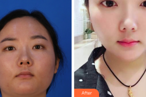 廣州曙光醫(yī)學(xué)美容醫(yī)院楊慧蘭整形價(jià)格表附皮膚管理案例展示