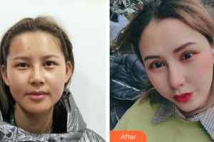 廣州韓妃醫(yī)學(xué)美容醫(yī)院李光琴整形價(jià)格表附格萊美眼部手術(shù)案例展示