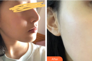 廣州華美醫(yī)療美容醫(yī)院易陽亮整形價(jià)格表附光子嫩膚案例展示