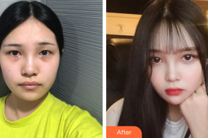 廣州華美醫(yī)療美容醫(yī)院李有真整形價(jià)格表附頜面整形案例展示