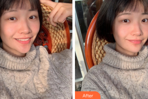 廣州華美醫(yī)療美容醫(yī)院郭曼麗整形價(jià)格表附水氧活膚案例展示