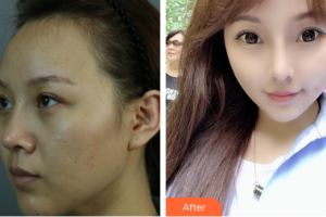 廣州時光整形美容醫(yī)院宋彥整形價格表附顴骨+頰脂墊+中面部提升術(shù)案例展示