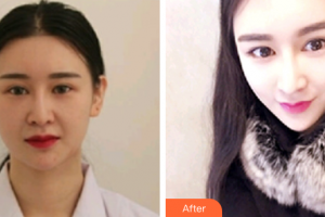 廣州時光整形美容醫(yī)院金相虎整形價格表附納米V-FACE分層吸脂術(shù)案例展示