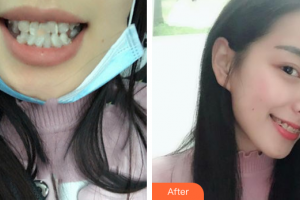 廣州韓妃醫(yī)學(xué)美容醫(yī)院徐建整形價格表附半隱形牙齒矯正案例展示