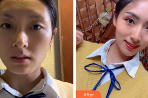 廣州市荔灣區(qū)人民醫(yī)院整形美容中心陳維整形價格表附埋線提升案例展示