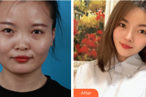 廣州市荔灣區(qū)人民醫(yī)院整形美容中心山口青木整形價格表附臉型（顴骨+下頜角）+鼻部手術(shù)案例展示