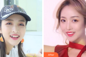 廣州華美醫(yī)療美容醫(yī)院鄭偉成整形價格表附牙齒矯正案例展示