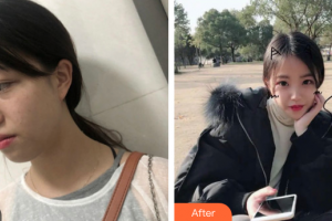 廣州海峽醫(yī)學(xué)整形美容醫(yī)院吳光興整形價格表附超激光美膚激光案例展示