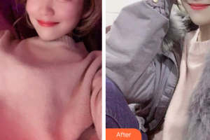 廣州海峽醫(yī)學(xué)整形美容醫(yī)院魏巍整形價格表附超聲波潔牙案例展示