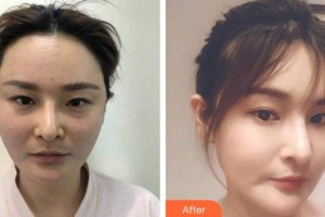 成都艾美醫(yī)療美容門診部徐乙茹整形價(jià)格表附埋線提升案例展示