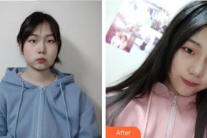 成都恩喜醫(yī)學整形美容醫(yī)院姜玄哲整形價格表附埋線提升案例展示