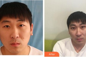 成都華康醫(yī)院美容整形外科錢凱整形價格表附切開雙眼皮案例展示