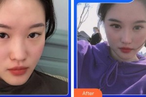 成都恩喜醫(yī)學整形美容醫(yī)院李光虎整形價格表附5S重瞼術(shù)+超微創(chuàng)開內(nèi)眥案例展示