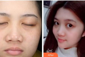 成都華康醫(yī)院美容整形外科李霞整形價格表附祛斑案例展示