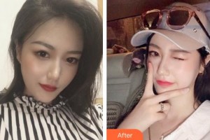 成都藝星醫(yī)療美容醫(yī)院謝雯整形價格表附嫩膚祛斑案例展示