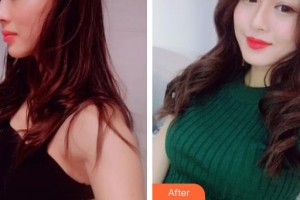 成都百齡駐顏醫(yī)學美容門診部康耀整形價格表附隆胸案例展示