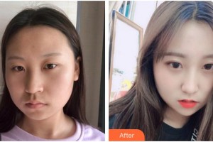 成都泊菲凱莉醫(yī)學整形美容醫(yī)院許文澍整形價格表附埋線提升案例展示