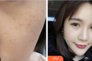 成都藝星醫(yī)療美容醫(yī)院方曉娟整形價格表附祛斑案例展示