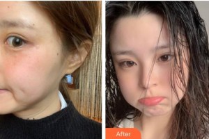 成都嬌點醫(yī)學美容醫(yī)院孫葉培整形價格表附激光美膚激光案例展示