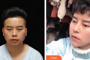 成都市錦江區(qū)第二人民醫(yī)院醫(yī)學美容科李蓉整形價格表附鼻部手術(shù)案例展示