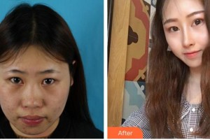 成都市錦江區(qū)第二人民醫(yī)院醫(yī)學美容科王嘉勛整形價格表附鼻整形案例展示