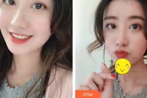 成都元辰醫(yī)學(xué)美容門診部巫國(guó)輝 整形價(jià)格表附面部填充案例展示