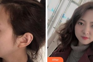 成都市錦江區(qū)第二人民醫(yī)院醫(yī)學(xué)美容科王鳳整形價(jià)格表附雙眼皮案例展示