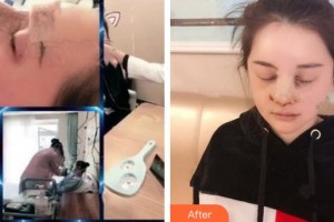 成都利美康爵麗醫(yī)療美容門診部薛塬峰整形價(jià)格表附隆鼻案例展示