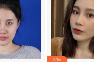 成都利美康爵麗醫(yī)療美容門診部梁靜萍整形價(jià)格表附埋線提升案例展示