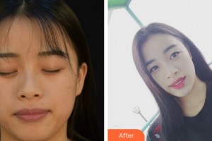 成都唯羅納醫(yī)療美容門診部羅佳整形價格表附抗衰抗初老案例展示