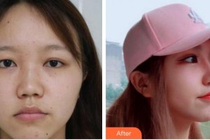 成都景華醫(yī)學美容門診部江濤整形價格表附鼻部手術案例展示