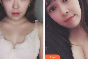 成都景華醫(yī)學美容門診部趙景華整形價格表附濃縮豐胸真實案例展示