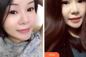 成都明星醫(yī)療美容門診部譚貴苗整形價格表附眼部綜合案例展示