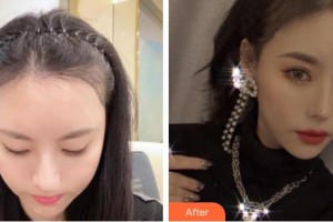 成都景華醫(yī)學美容門診部楊杰整形價格表附發(fā)際線案例展示